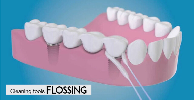Implant Tooth: Flossing