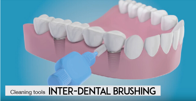 Implant Tooth:: Inter Dental Brushing