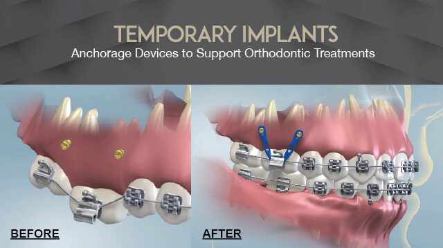 Temporary Implants - Mini Implants